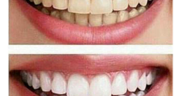 Giải đáp các câu hỏi về tẩy trắng răng tại Phòng khám nha khoa thẩm mỹ JK Dental