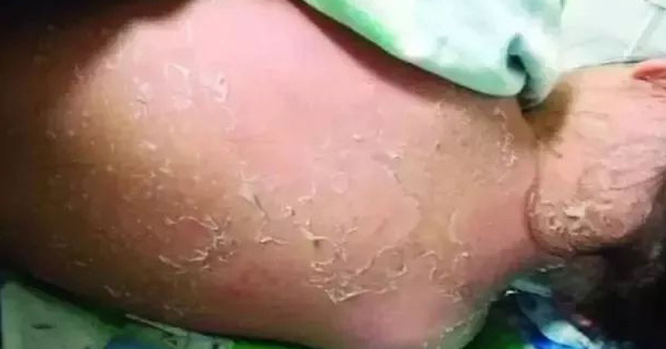 Bé gái 8 tuổi bị nổi nốt đỏ ở khóe miệng, rụng cả mảng da lớn sau khi tắm tại bể bơi công cộng