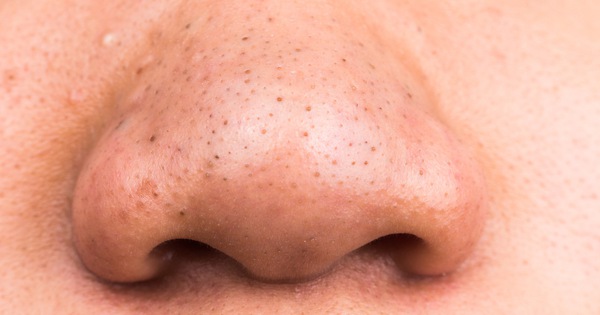 Người có gan kém thường có 3 biểu hiện "tối đen" trên khuôn mặt, check xem bạn có biểu hiện nào hay không