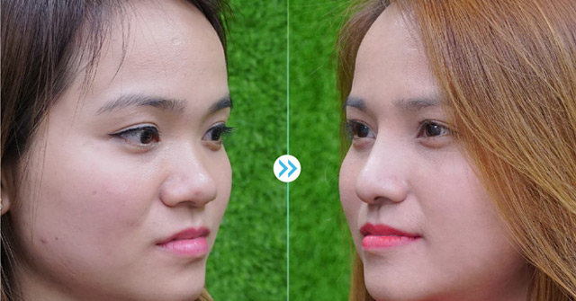 Hé lộ nguyên nhân khiến Việt kiều tìm đến thẩm mỹ viện Newface nâng mũi