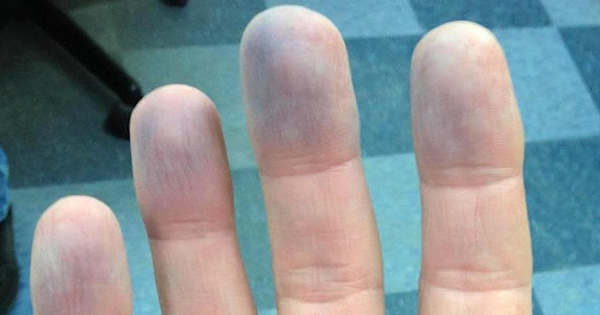 3 dấu hiệu bất thường ở ngón tay đang tố cáo bệnh phổi, hãy đến gặp bác sĩ ngay
