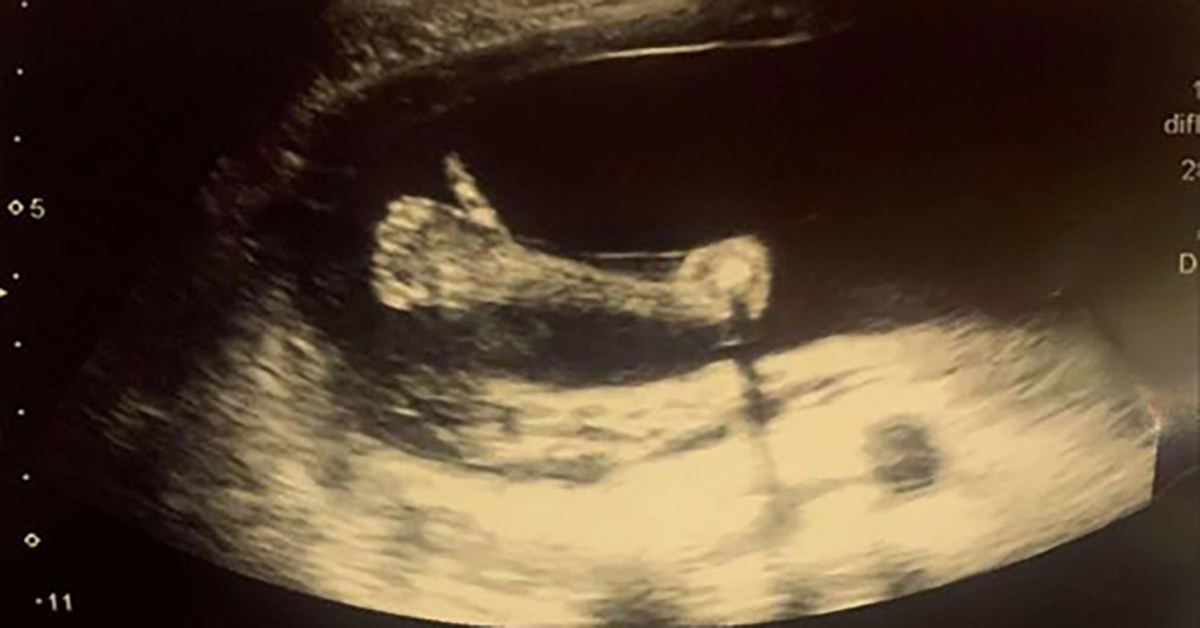 Mẹ bầu đi siêu âm thai tuần 20, em bé có hành động "siêu ngầu" làm y tá reo lên