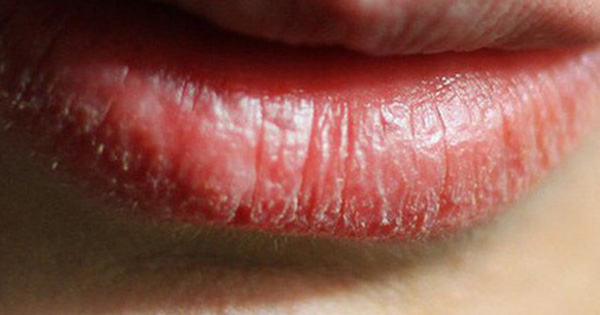 Người có gan xấu thường có 4 biểu hiện trên môi, mong rằng bạn không gặp điều nào