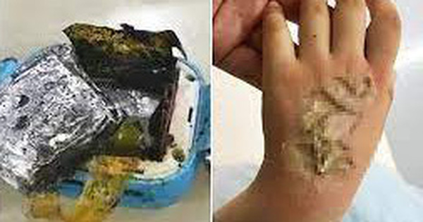 Bé gái 4 tuổi phải ghép da sau khi bị bỏng nặng cấp độ 3 ở mu bàn tay vì chiếc đồng hồ thông minh bỗng dưng bốc cháy dữ dội