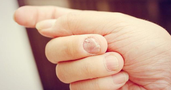 Những người gan tốt thường không có 3 biểu hiện này trên tay, kiểm tra ngay để nắm được tình hình sức khỏe