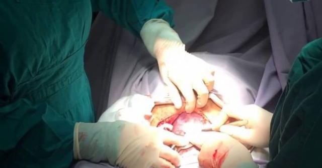 Mẹ bầu mang thai 8 tháng ngã rồi đẻ non, bác sĩ bàng hoàng khi nhìn tử cung