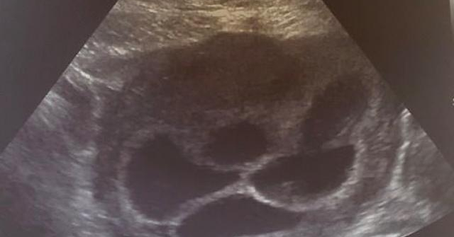 Cặp đồng tính nữ đi "xin giống" sinh con, lần đầu đi siêu âm bác sĩ báo có 5 thai